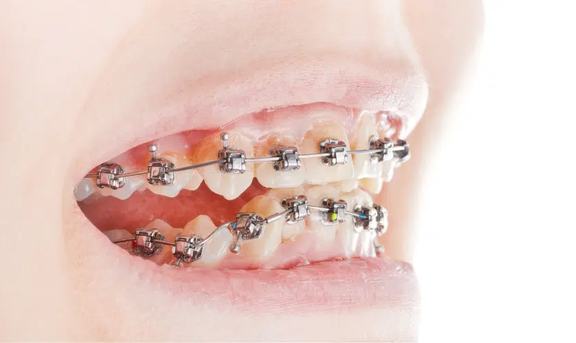 What Are Damon’s Braces & How Are They Made?