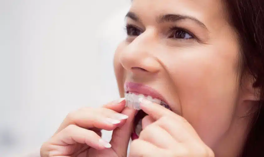 Everything You Need To Know About Invisalign Teen