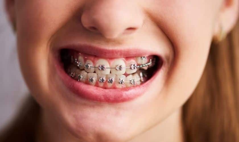List Of Oral Hygiene You Must Follow While Having Braces.