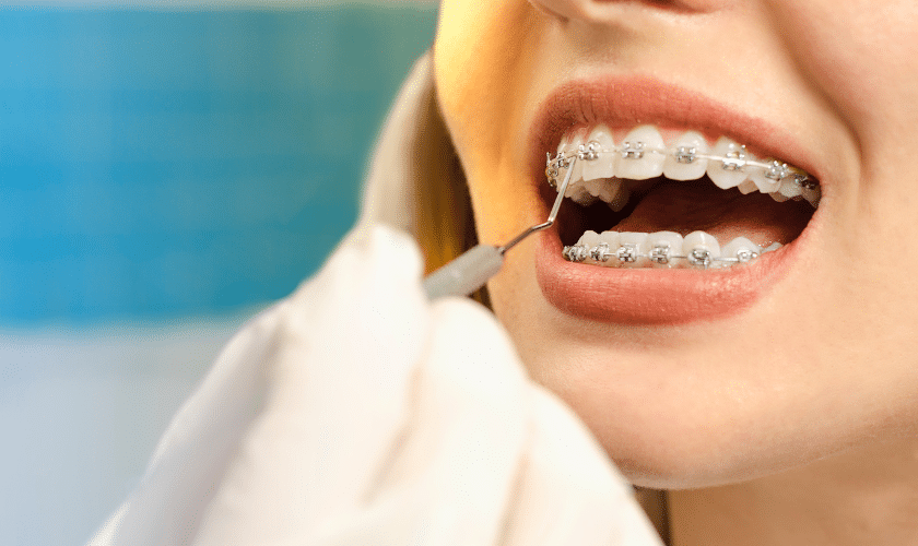 Behind the Braces: A Comprehensive Guide to Orthodontics