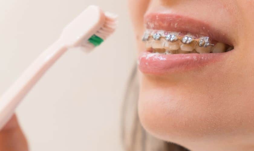 Clean Teeth, Confident Smile: Brushing with Braces Made Easy